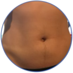 Abdominal Massage Training